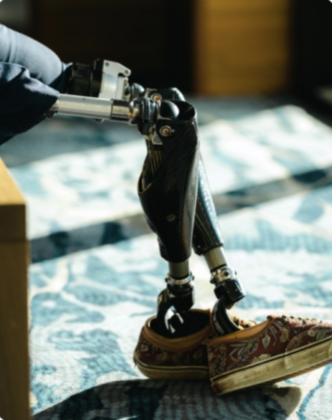 Close-up of an OPRA™ Implant System patient's legs sitting.