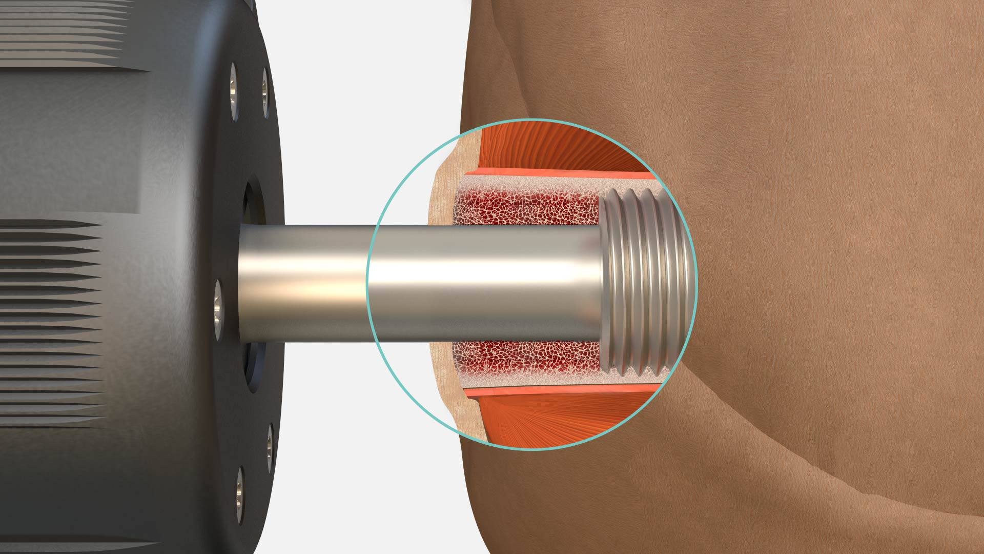 Illustration of OPRA™ Implant System.