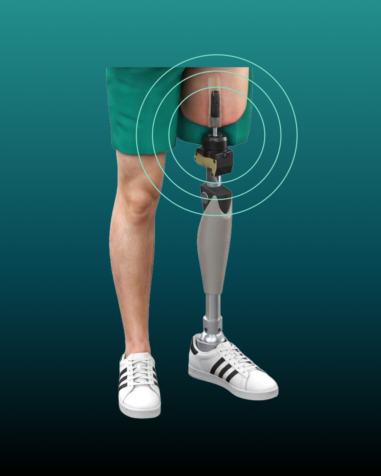 Infographic of person with bone-anchored prosthetic leg standing.