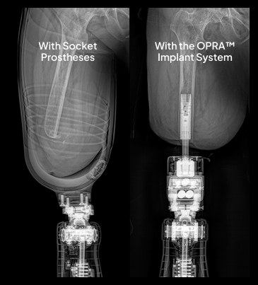 X-ray showing side-by-side socket prosthesis and OPRA™ Implant System.