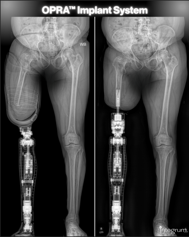 X-ray showing side-by-side socket prosthesis and OPRA™ Implant System.
